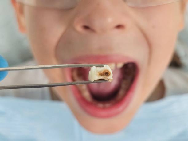Best Emergency Dental Care for Broken or Chipped Teeth in Harleigh, PA
